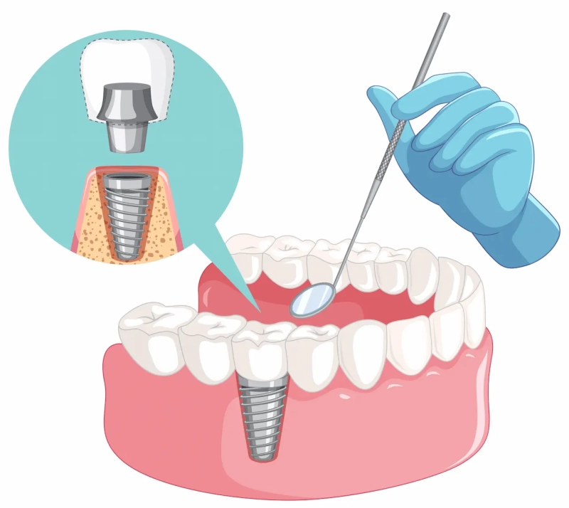 Voordelen en nadelen van tandheelkundige implantaten 